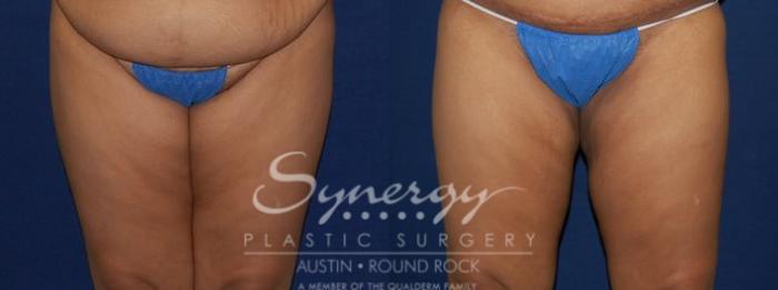 Before & After Liposuction Case 77 View #1 View in Austin, TX