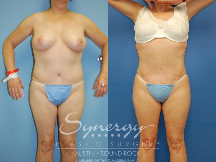 Before & After Liposuction Case 8 View #1 View in Austin, TX