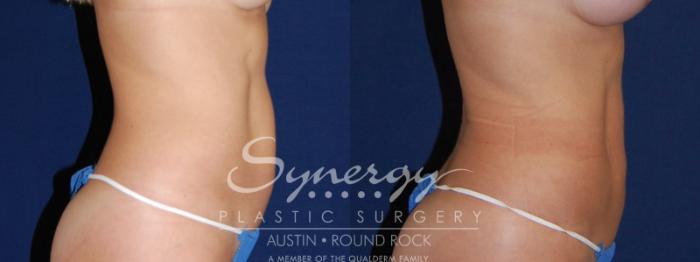 Before & After Liposuction Case 84 View #2 View in Austin, TX