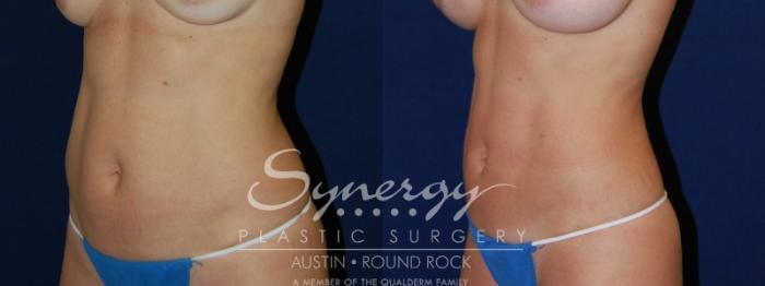 Before & After Liposuction Case 84 View #3 View in Austin, TX