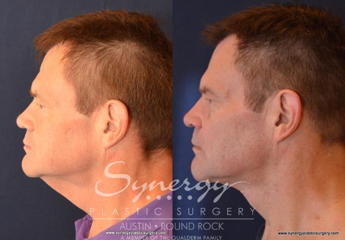 Before & After Neck Lift (Cervicoplasty) Case 601 View #1 View in Austin, TX