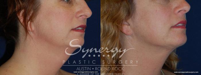 Before & After Neck Liposuction Case 159 View #1 View in Austin, TX