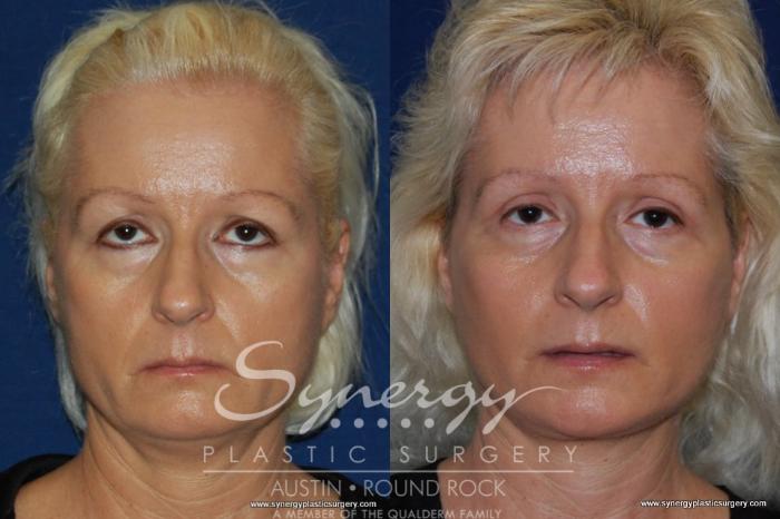 Before & After Neck Liposuction Case 194 View #1 View in Austin, TX