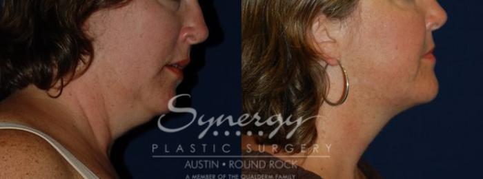 Before & After Neck Liposuction Case 68 View #1 View in Austin, TX