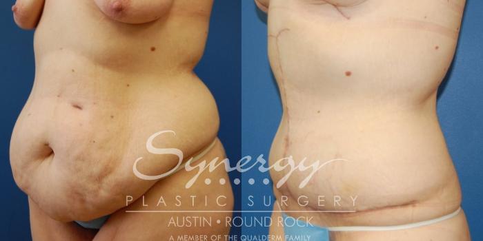 Before & After Post Weight Loss Surgery Case 31 View #1 View in Austin, TX