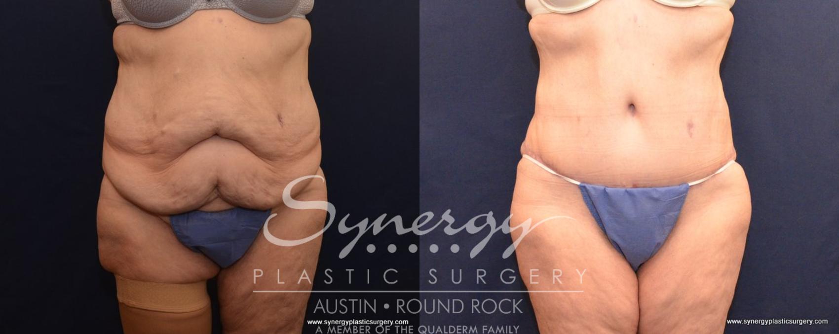Before & After Post Weight Loss Surgery Case 499 View #1 View in Austin, TX
