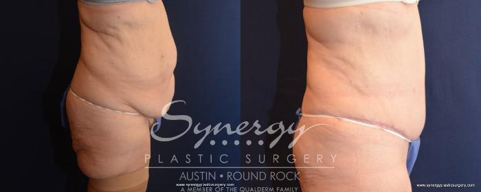 Before & After Post Weight Loss Surgery Case 499 View #2 View in Austin, TX