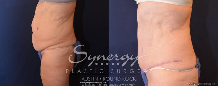 Before & After Post Weight Loss Surgery Case 499 View #4 View in Austin, TX