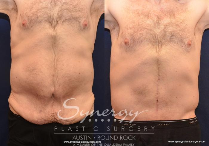 Before & After Post Weight Loss Surgery Case 599 View #1 View in Austin, TX