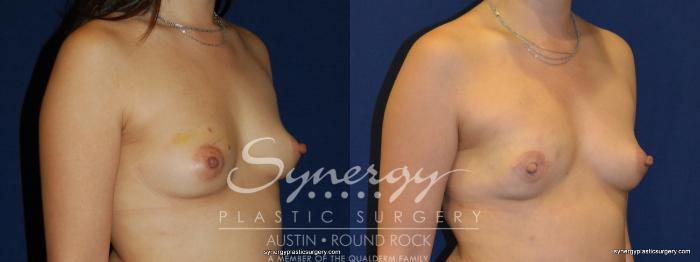 Before & After Reconstruction - Breast Cancer Case 236 View #1 View in Austin, TX