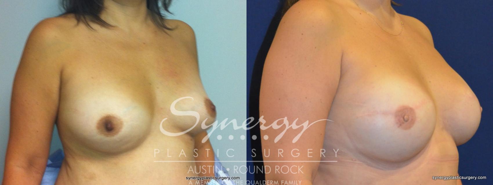 Before & After Reconstruction - Breast Cancer Case 238 View #1 View in Austin, TX