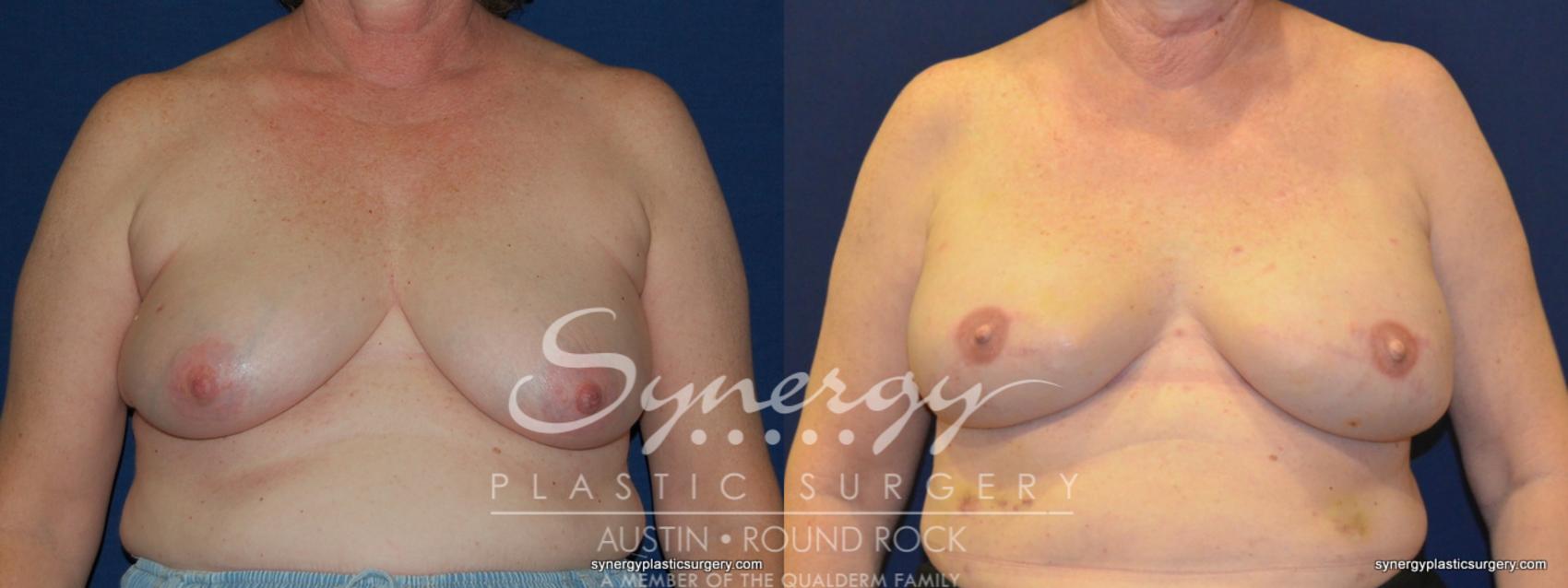 Before & After Reconstruction - Breast Cancer Case 247 View #1 View in Austin, TX