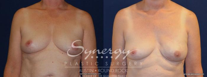 Before & After Reconstruction - Breast Cancer Case 254 View #1 View in Austin, TX