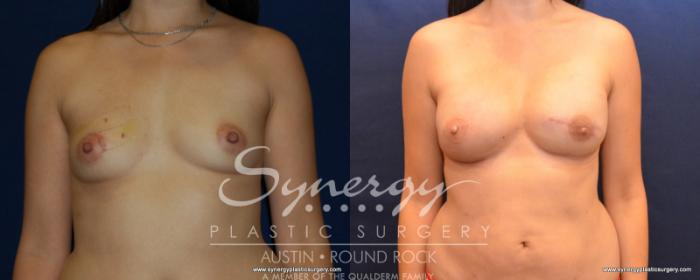 Before & After Reconstruction - Breast Cancer Case 540 View #1 View in Austin, TX