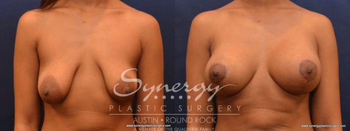 Before & After Reconstruction - Congenital Breast Case 568 View #1 View in Austin, TX