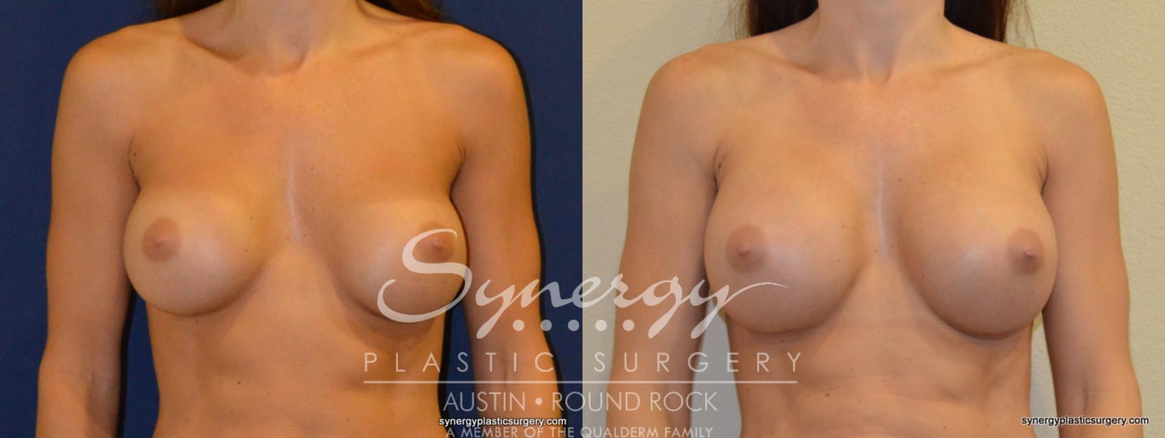 Before & After Revision Breast Augmentation Case 234 View #1 View in Austin, TX