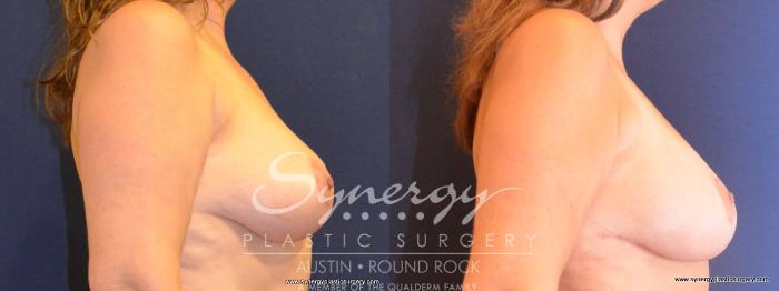 Before & After Revision Breast Augmentation Case 421 View #2 View in Austin, TX