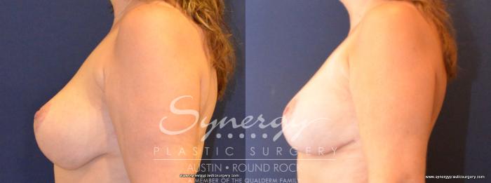 Before & After Revision Breast Augmentation Case 421 View #4 View in Austin, TX