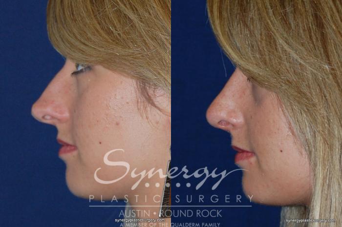 Before & After Rhinoplasty Case 200 View #2 View in Austin, TX