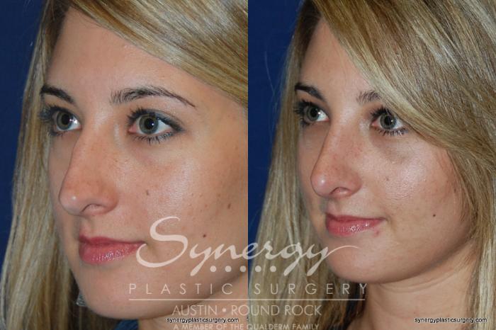 Before & After Rhinoplasty Case 200 View #3 View in Austin, TX
