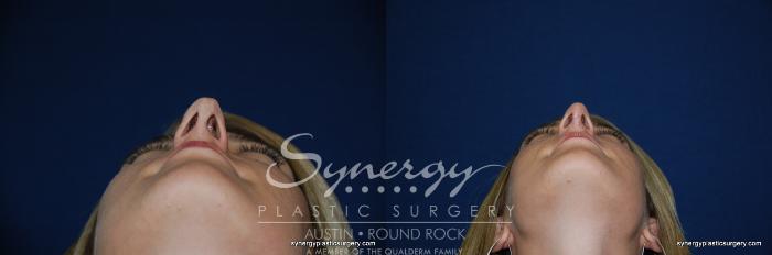 Before & After Rhinoplasty Case 200 View #5 View in Austin, TX