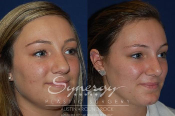 Before & After Rhinoplasty Case 44 View #1 View in Austin, TX