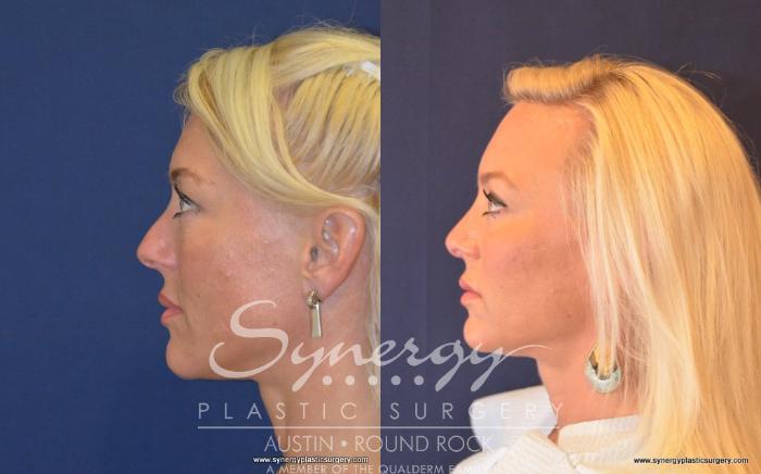 Before & After Rhinoplasty Case 488 View #1 View in Austin, TX