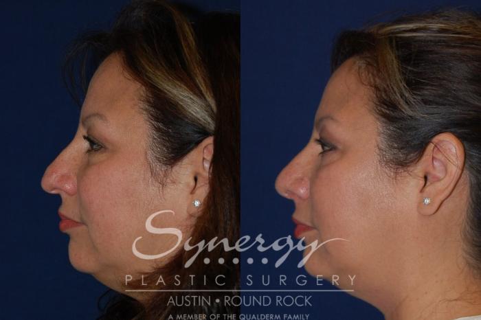 Before & After Rhinoplasty Case 89 View #1 View in Austin, TX