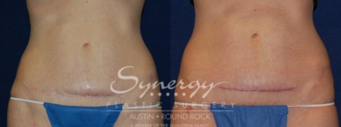Before & After Scar Revision Case 51 View #1 View in Austin, TX