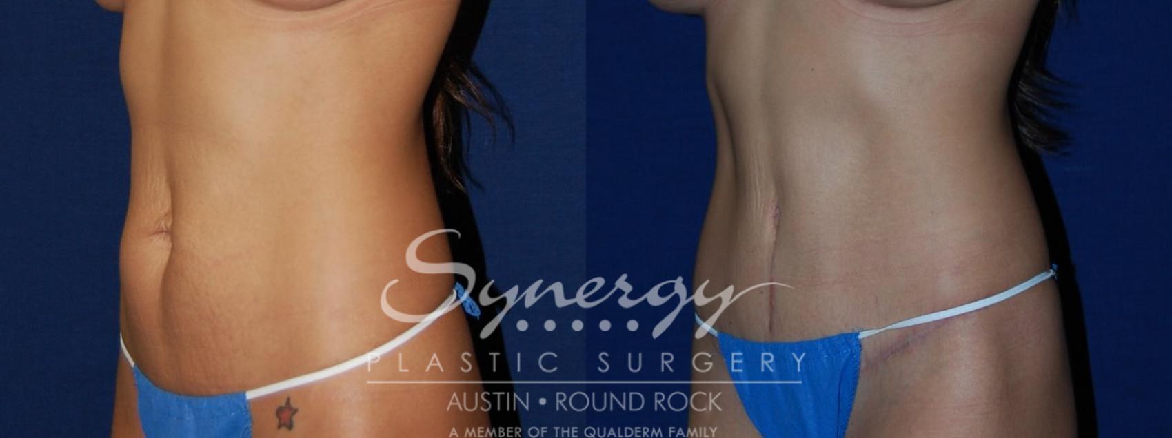 Before & After Abdominoplasty (Tummy Tuck) Case 102 View #1 View in Austin, TX