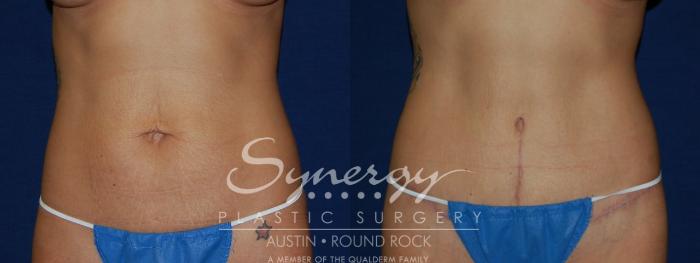 Before & After Abdominoplasty (Tummy Tuck) Case 102 View #2 View in Austin, TX