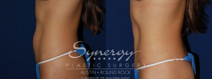 Before & After Abdominoplasty (Tummy Tuck) Case 102 View #3 View in Austin, TX