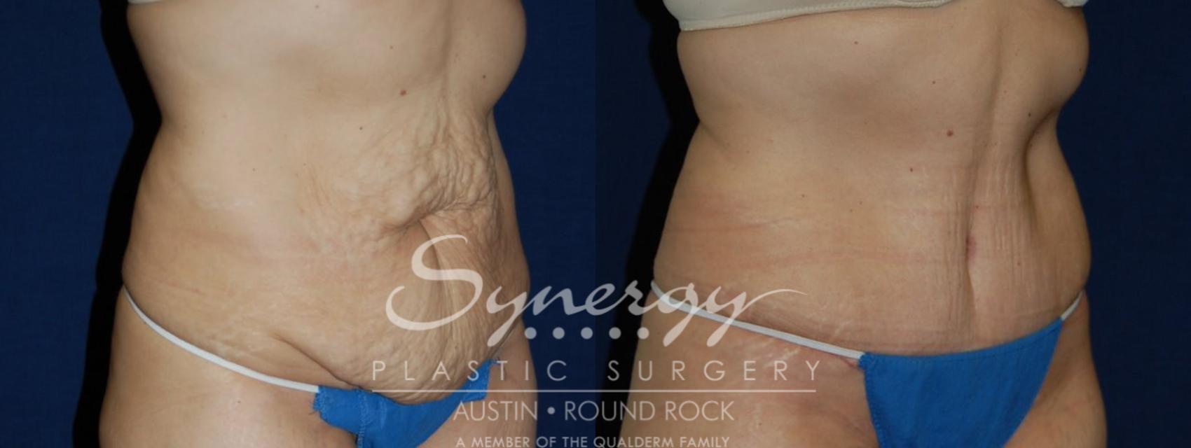 Before & After Abdominoplasty (Tummy Tuck) Case 103 View #1 View in Austin, TX