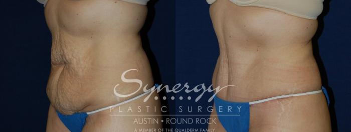 Before & After Abdominoplasty (Tummy Tuck) Case 103 View #2 View in Austin, TX