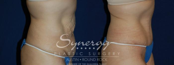 Before & After Abdominoplasty (Tummy Tuck) Case 103 View #3 View in Austin, TX