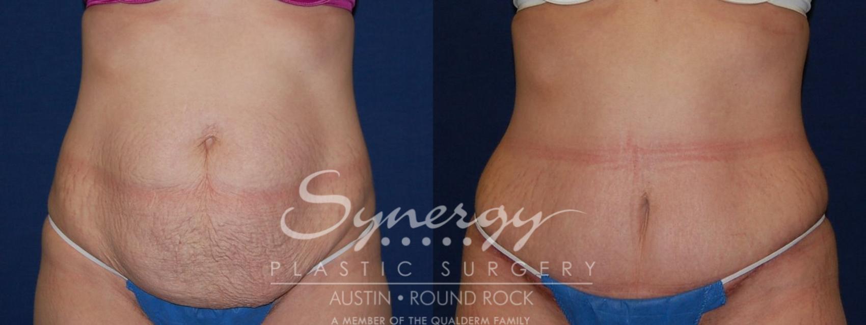 Before & After Abdominoplasty (Tummy Tuck) Case 105 View #1 View in Austin, TX