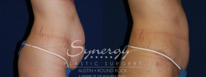 Before & After Abdominoplasty (Tummy Tuck) Case 105 View #2 View in Austin, TX