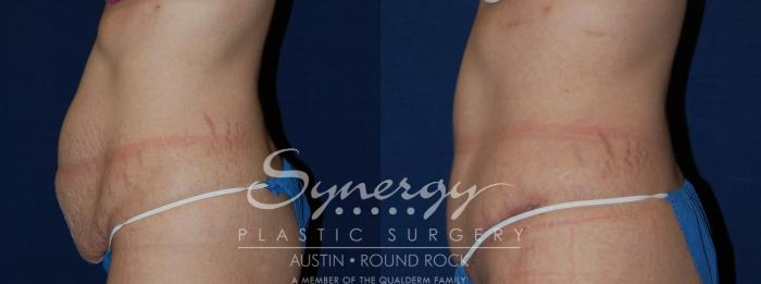 Before & After Abdominoplasty (Tummy Tuck) Case 105 View #3 View in Austin, TX