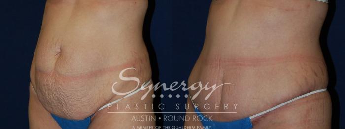 Before & After Abdominoplasty (Tummy Tuck) Case 105 View #4 View in Austin, TX