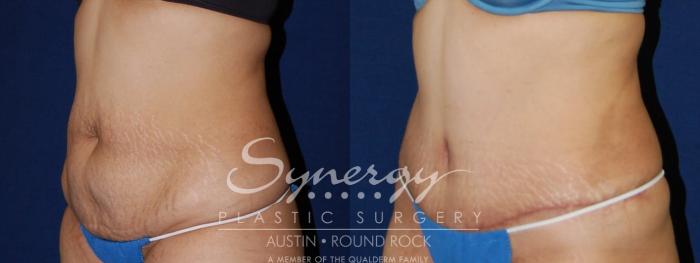 Before & After Abdominoplasty (Tummy Tuck) Case 106 View #1 View in Austin, TX