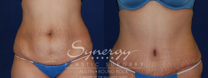 Before & After Abdominoplasty (Tummy Tuck) Case 106 View #2 View in Austin, TX