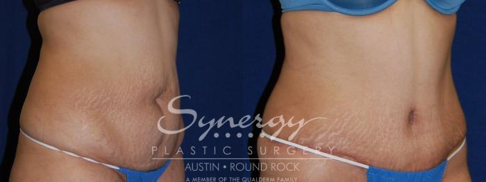 Before & After Abdominoplasty (Tummy Tuck) Case 106 View #3 View in Austin, TX