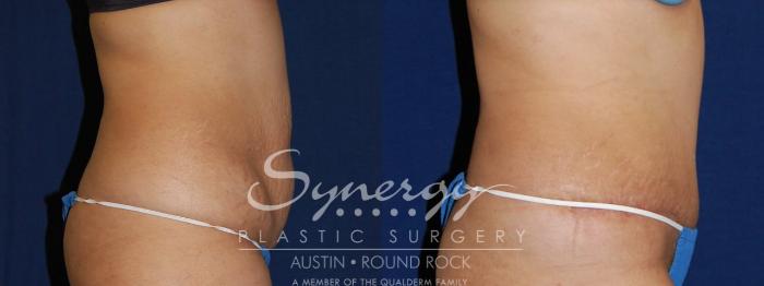 Before & After Abdominoplasty (Tummy Tuck) Case 106 View #4 View in Austin, TX