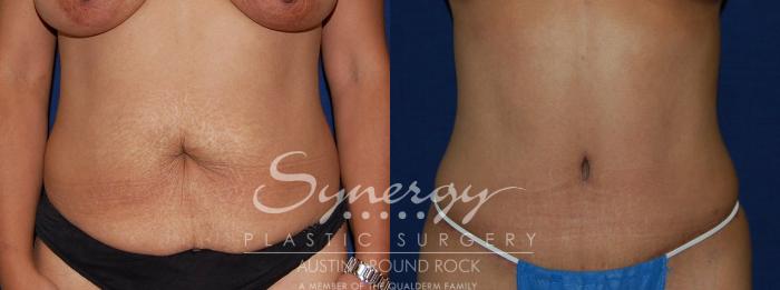 Tummy Tuck, Abdominoplasty