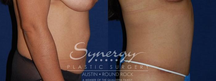 Before & After Abdominoplasty (Tummy Tuck) Case 112 View #3 View in Austin, TX