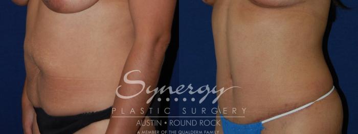 Before & After Abdominoplasty (Tummy Tuck) Case 112 View #4 View in Austin, TX