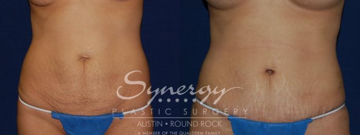 Before & After Abdominoplasty (Tummy Tuck) Case 115 View #1 View in Austin, TX