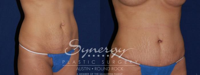 Before & After Abdominoplasty (Tummy Tuck) Case 115 View #2 View in Austin, TX
