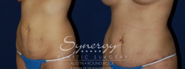 Before & After Abdominoplasty (Tummy Tuck) Case 115 View #3 View in Austin, TX