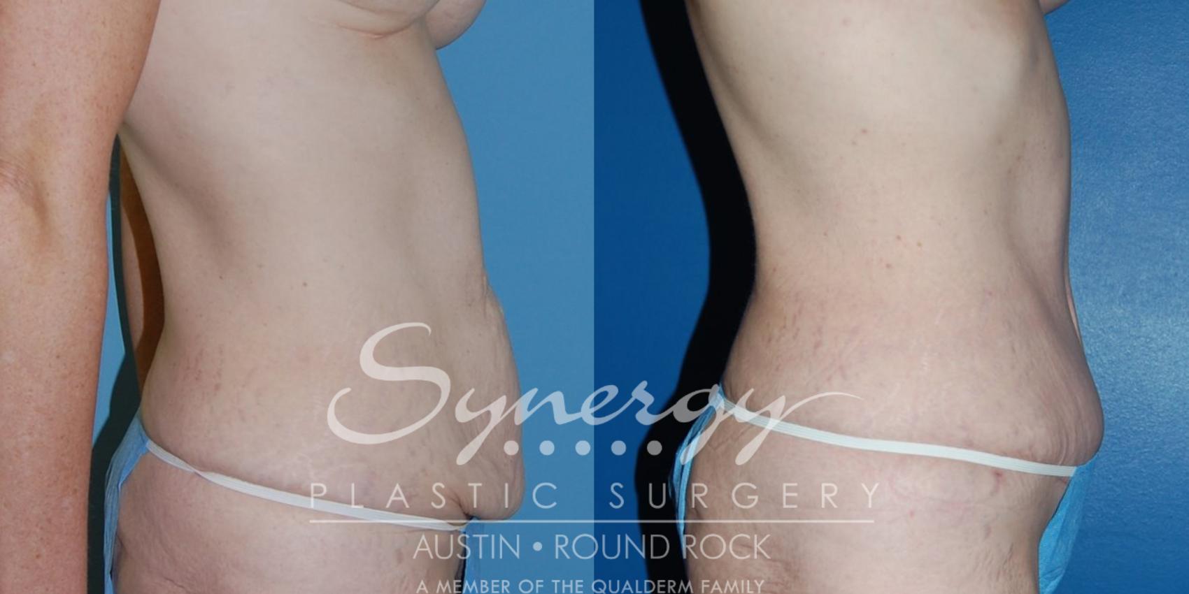 Before & After Abdominoplasty (Tummy Tuck) Case 13 View #1 View in Austin, TX